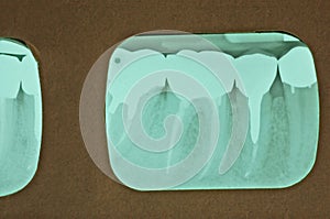 Multiple Root Canals