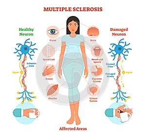 Multiple sclerosis anatomical vector illustration diagram, medical scheme.