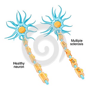 Multiple sclerosis. autoimmune disease