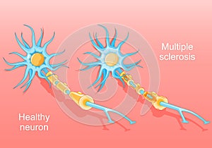 Multiple sclerosis. Autoimmune disease