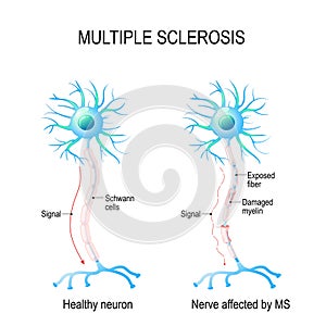 Multiple sclerosis. autoimmune disease.