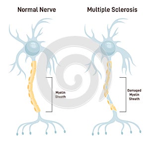 Multiple sclerosis. Autoimmune disease affecting the central nervous system.