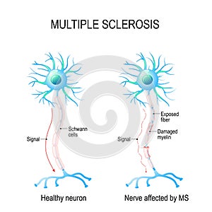 Multiple sclerosis. autoimmune disease. photo