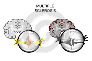 Multiple sclerosis of the brain