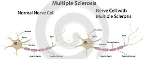 Multiple Sclerosis Diagram