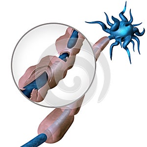 Multiple Sclerosis Diagram photo