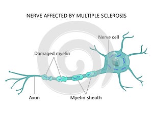 Multiple Sclerosis Failure Myelin Cells Autoimmune Disease photo