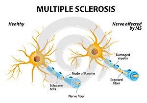Múltiple esclerosis 