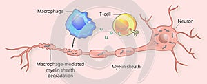 Multiple sclerosis and myelin sheath breakdown