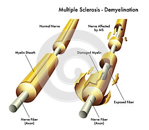 Multiple sclerosis nerve damage