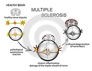 Multiple sclerosis. Neurology