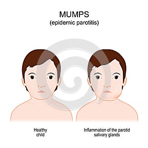 Mumps. Epidemic parotitis. viral disease