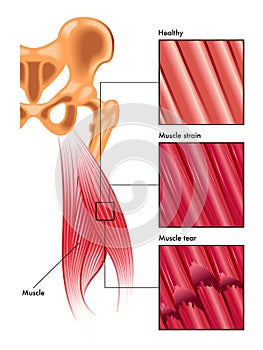 Muscle strain and tear photo