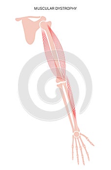 Muscular dystrophy of arm