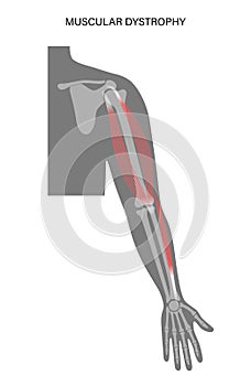 Muscular dystrophy of arm