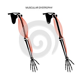 Muscular dystrophy of arm