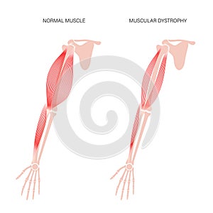 Muscular dystrophy of arm