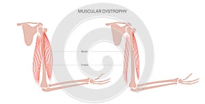 Muscular dystrophy of arm