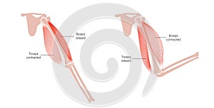 Muscular dystrophy of arm