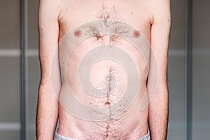 Muscular dystrophy of a man with a protrusion of the abdomen photo