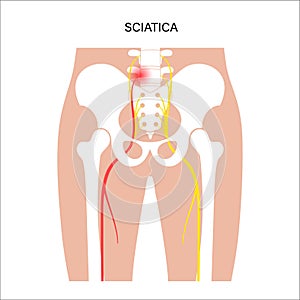 Muscular pelvis sciatica