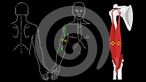 Musculus biceps brachii. Biceps trigger points and pain photo
