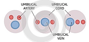 Mutual position of the umbilical cord vessels