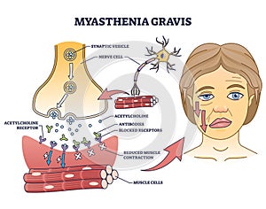 Myasthenia gravis as autoimmune, neuromuscular disease outline diagram photo