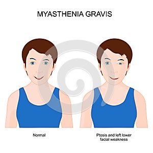 Myasthenia gravis. Girl with neuromuscular disease