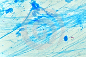 Mycobacterium positive in acid fast stain sputum photo
