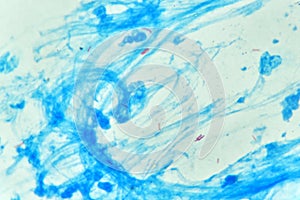 Mycobacterium positive in acid fast stain sputum photo