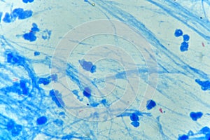 Mycobacterium positive in sputum