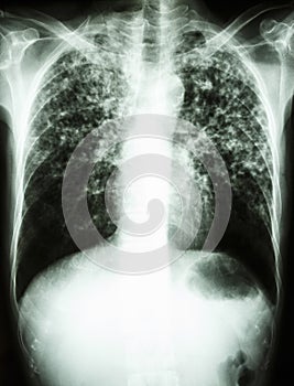 Mycobacterium tuberculosis infection (Pulmonary Tuberculosis)