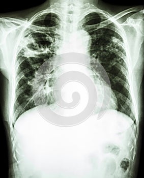 Mycobacterium tuberculosis infection (Pulmonary Tuberculosis)