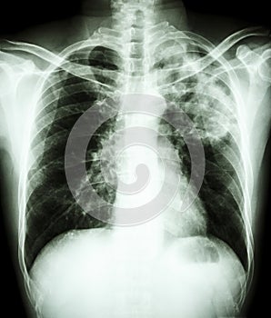 Mycobacterium tuberculosis infection (Pulmonary Tuberculosis)