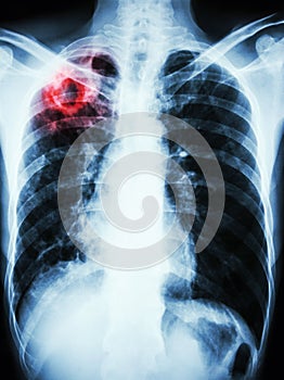 Mycobacterium tuberculosis infection (Pulmonary Tuberculosis)