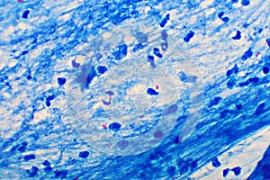 Mycobacterium tuberculosis positive in sputum smear photo