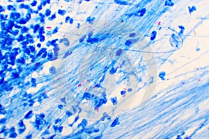 Mycobacterium tuberculosis positive in sputum smear