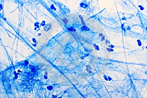 Mycobacterium tuberculosis positive in sputum smear