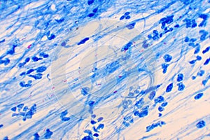 Mycobacterium tuberculosis positive in sputum smear