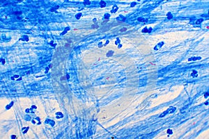 Mycobacterium tuberculosis positive in sputum smear