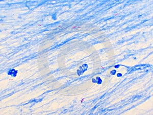 Mycobacterium tuberculosis positive in sputum smear photo