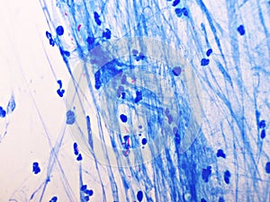 Mycobacterium tuberculosis positive in sputum smear photo