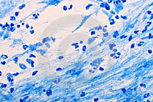 Mycobacterium tuberculosis positive in sputum smear photo