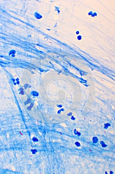 Mycobacterium tuberculosis positive in sputum smear photo