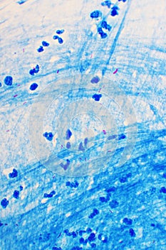 Mycobacterium tuberculosis positive in sputum smear photo