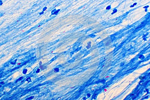 Mycobacterium tuberculosis positive in sputum smear photo