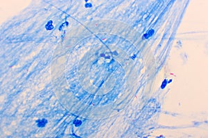 Mycobacterium tuberculosis positive in sputum smear photo