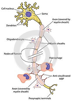 Myelinated nerve in multiple sclerosis