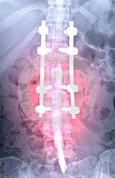 myelography is particularly sensitive at detecting small disk herniations compressing nerves.